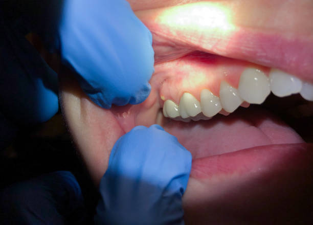 Best Knocked-Out Tooth Emergency  in Interlachen, FL